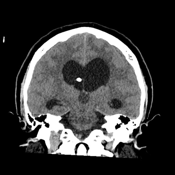 File:Chiasmatic-hypothalamic juvenile pilocytic astrocytoma (Radiopaedia 78533-91237 Coronal non-contrast 40).jpg