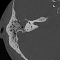 Cholesteatoma (Radiopaedia 15846-15494 bone window 9).jpg