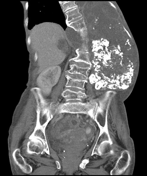 File:Chondrosarcoma of the spine (Radiopaedia 49871-55143 B 13).jpg