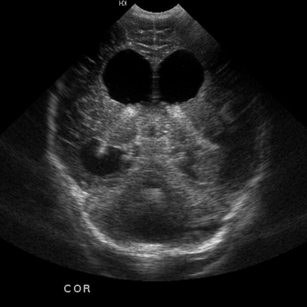 File:Choroid plexus carcinoma (Radiopaedia 21121-21033 A 18).jpg