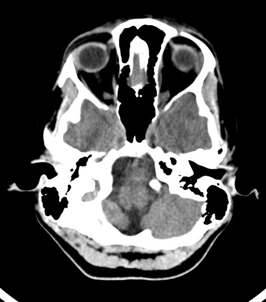 File:Choroid plexus carcinoma (Radiopaedia 91013-108552 Axial non-contrast 14).jpg