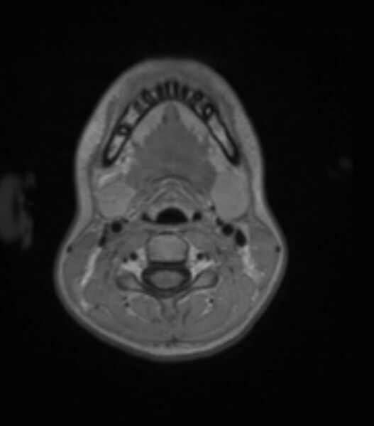 File:Choroid plexus carcinoma (Radiopaedia 91013-108553 Axial T1 C+ 22).jpg