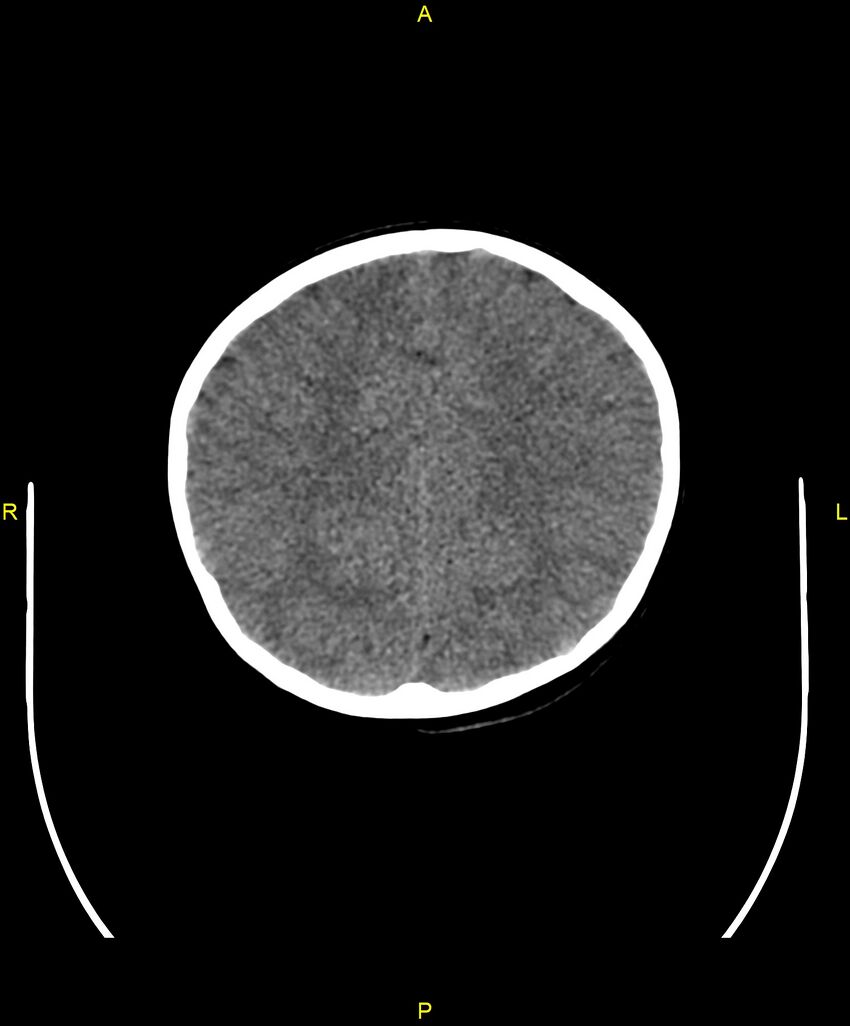 Choroidal fissure cyst (Radiopaedia 89481-106465 Axial non-contrast 86).jpg