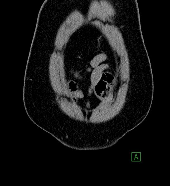 File:Chromophobe renal cell carcinoma (Radiopaedia 84286-99573 Coronal non-contrast 13).jpg