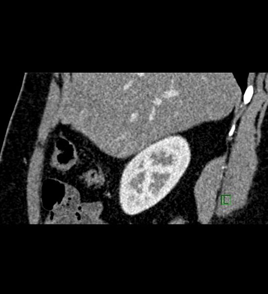File:Chromophobe renal cell carcinoma (Radiopaedia 84286-99573 F 131).jpg