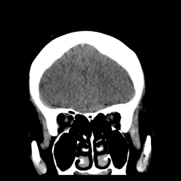 File:Chronic bilateral occipital lobe infarcts (Radiopaedia 31276-31996 Coronal non-contrast 14).jpg