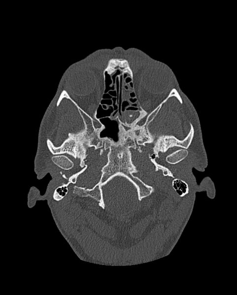 File:Chronic maxillary sinusitis caused by a foreign body (Radiopaedia 58521-65676 Axial bone window 195).jpg