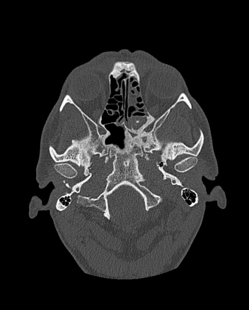 Chronic maxillary sinusitis caused by a foreign body (Radiopaedia 58521-65676 Axial bone window 195).jpg