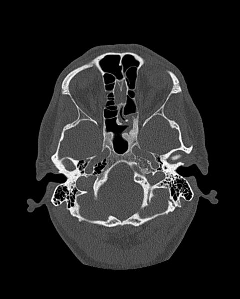 File:Chronic maxillary sinusitis caused by a foreign body (Radiopaedia 58521-65676 Axial bone window 222).jpg