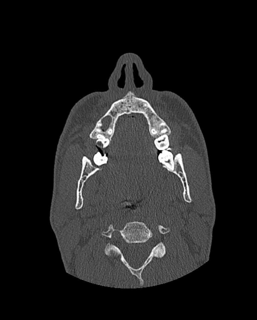 Chronic maxillary sinusitis caused by a foreign body (Radiopaedia 58521-65676 Axial bone window 33).jpg