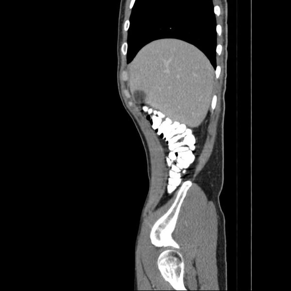 File:Chronic pancreatitis (Radiopaedia 21022-20949 D 17).jpg