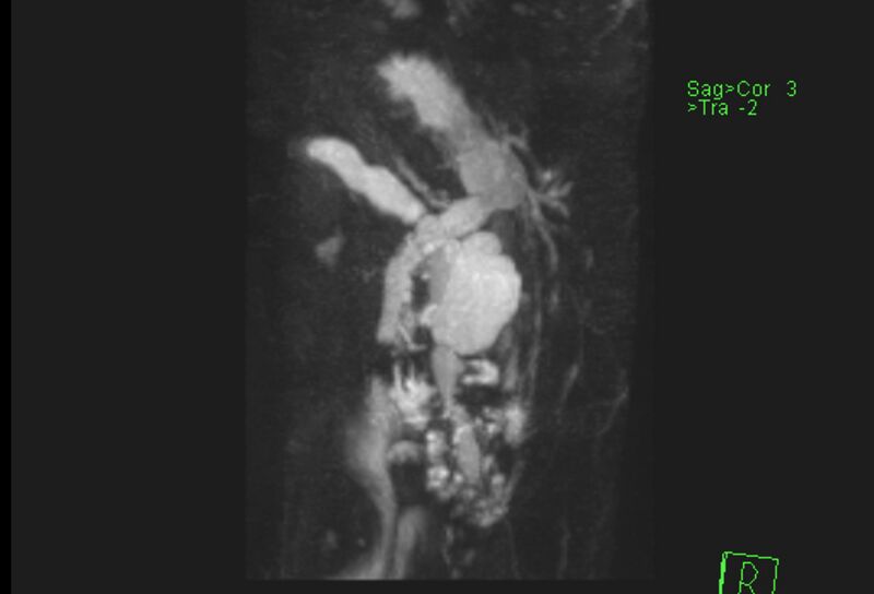 File:Chronic pancreatitis - pancreatic duct calculi (Radiopaedia 71818-82250 MRCP T2 6).jpg