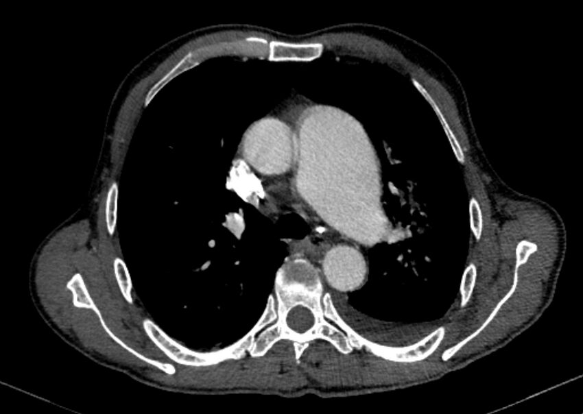 Chronic pulmonary embolism with bubbly consolidation (Radiopaedia 91248-108850 C+ arterial phase 53).jpg