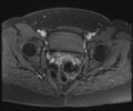Class II Mullerian duct anomaly- unicornuate uterus with rudimentary horn and non-communicating cavity (Radiopaedia 39441-41755 Axial T1 fat sat 96).jpg