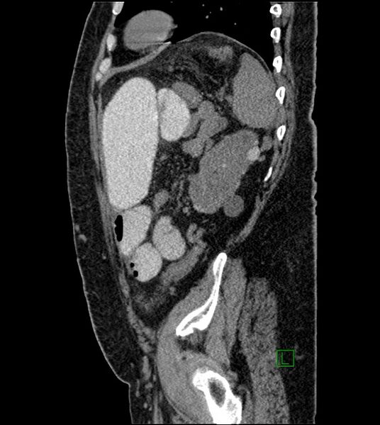 File:Closed-loop small bowel obstruction-internal hernia (Radiopaedia 78439-91096 C 41).jpg