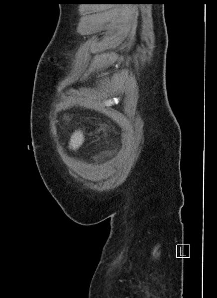 File:Closed loop obstruction - internal hernia into nephrectomy bed (Radiopaedia 59867-67320 C 106).jpg