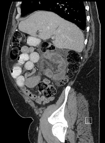 File:Closed loop obstruction - internal hernia into nephrectomy bed (Radiopaedia 59867-67320 C 77).jpg