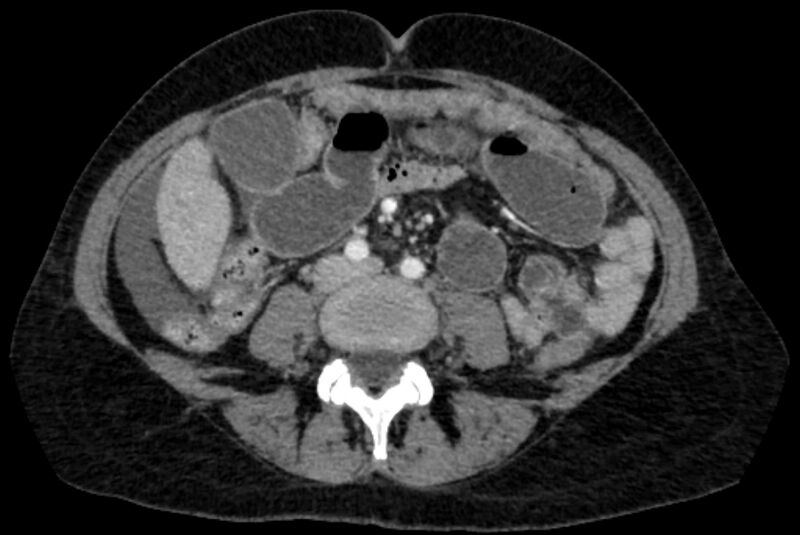 File:Closed loop small bowel obstruction (Radiopaedia 71211-81508 A 73).jpg