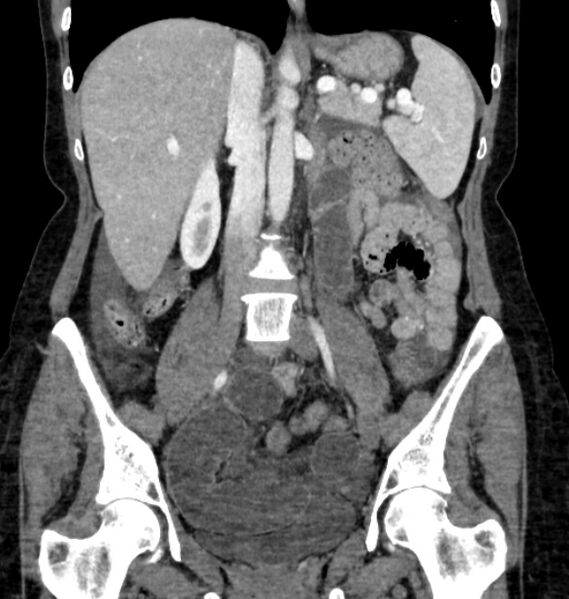 File:Closed loop small bowel obstruction (Radiopaedia 71211-81508 B 65).jpg