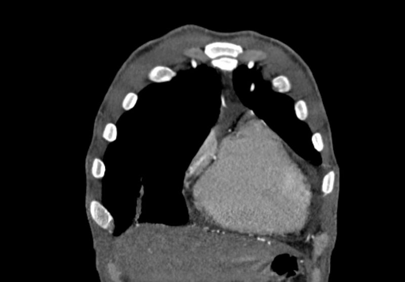 File:Coarctation of aorta with aortic valve stenosis (Radiopaedia 70463-80574 C 19).jpg
