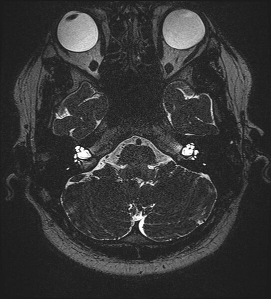 File:Cochlear incomplete partition type III associated with hypothalamic hamartoma (Radiopaedia 88756-105498 Axial T2 63).jpg