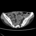 Colocolic fistula - Crohn disease (Radiopaedia 57063-63955 A 71).jpg