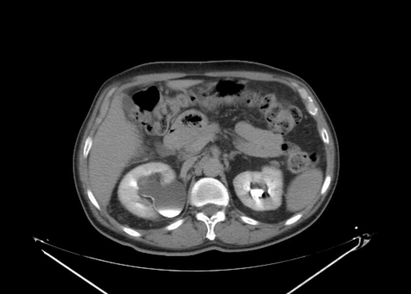 File:Colon cancer mimicking renal cell carcinoma (Radiopaedia 28986-29335 Axial C+ delayed 24).jpg
