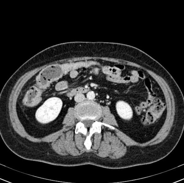 File:Colon carcinoma with hepatic metastases (Radiopaedia 29477-29961 A 58).jpg