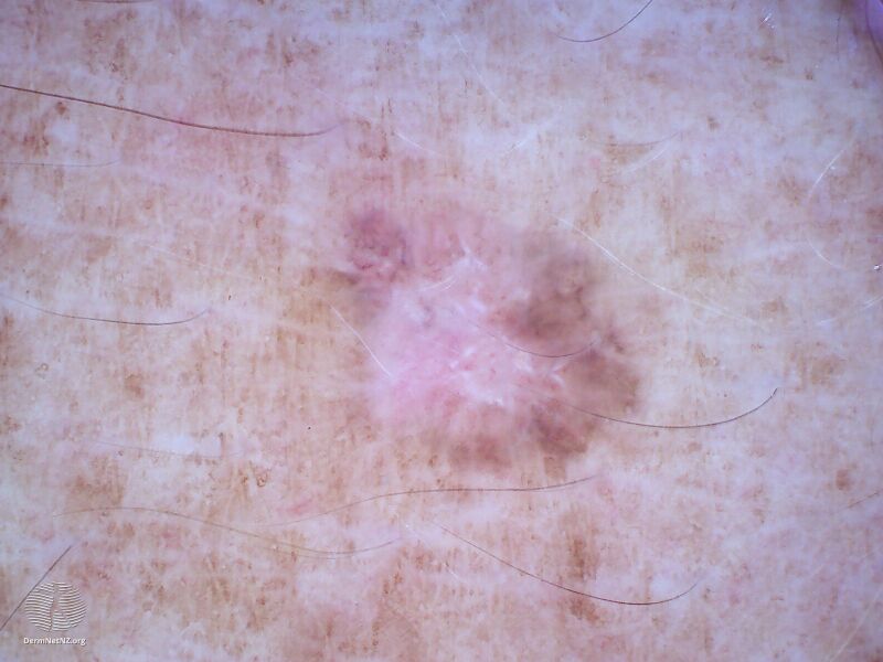 File:Dermoscopic image of amelanotic melanoma 4 (DermNet NZ amelanotic-melanoma4-dermoscopic).jpg