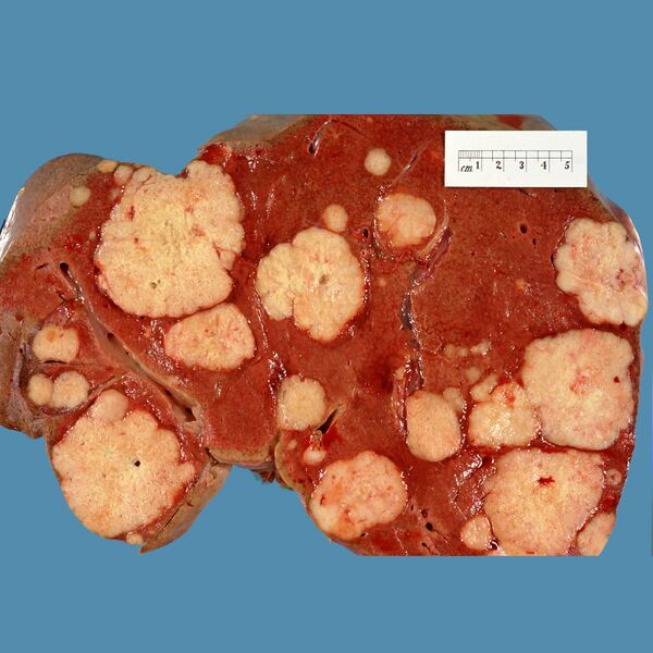 File:Liver metastases (gross pathology) (Radiopaedia 9521).jpg