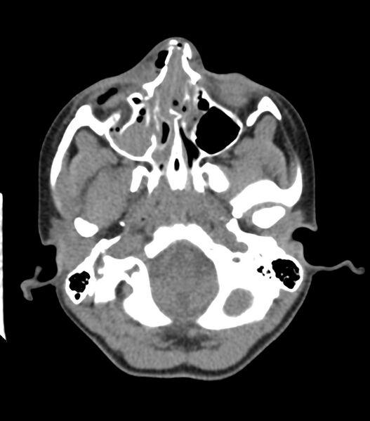 File:Nasoorbitoethmoid fracture (Radiopaedia 90044-107205 Axial non-contrast 138).jpg