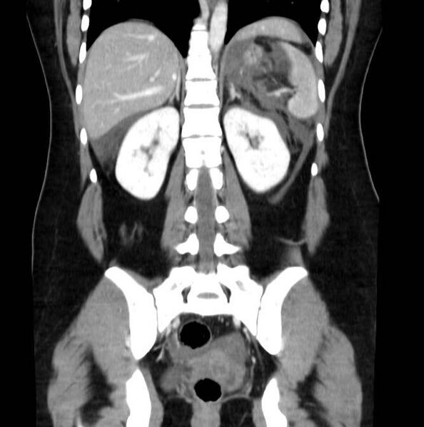 File:Necrotizing pancreatitis (Radiopaedia 23001-23031 B 46).jpg