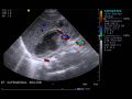 Neonatal adrenal hemorrhage (Radiopaedia 40215-42751 D 1).JPG