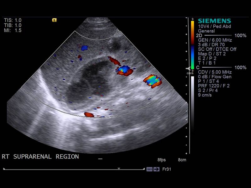 File:Neonatal adrenal hemorrhage (Radiopaedia 40215-42751 D 1).JPG