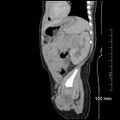 Neonatal neuroblastoma (Radiopaedia 56651-63438 C 29).jpg