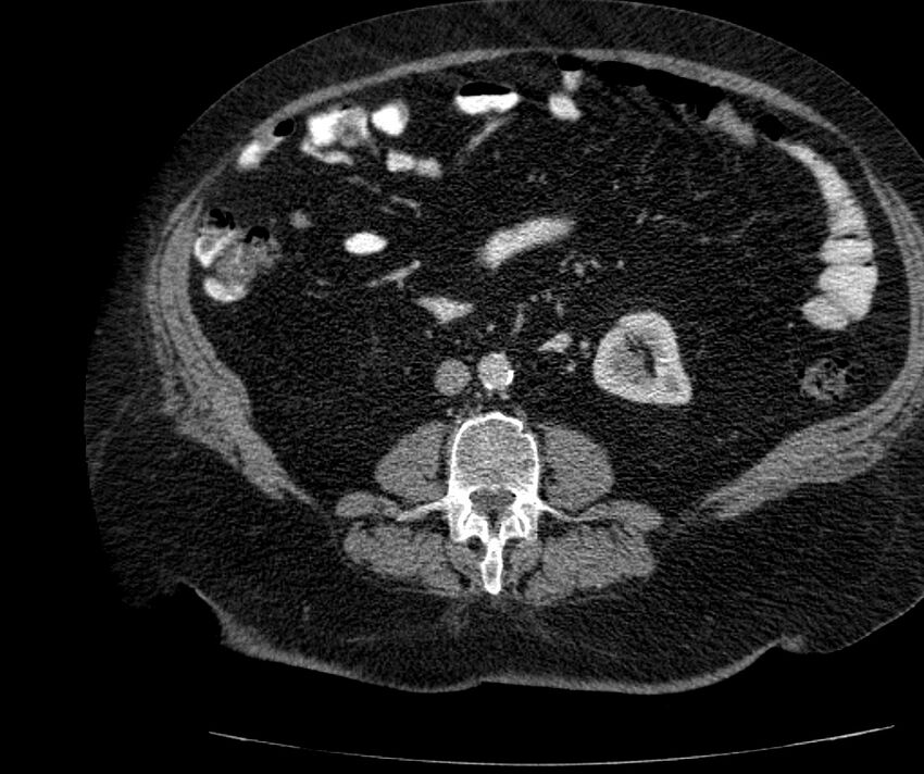 Nephroptosis with inguinal hernia containing perirenal fat (Radiopaedia 56632-63391 C 183).jpg