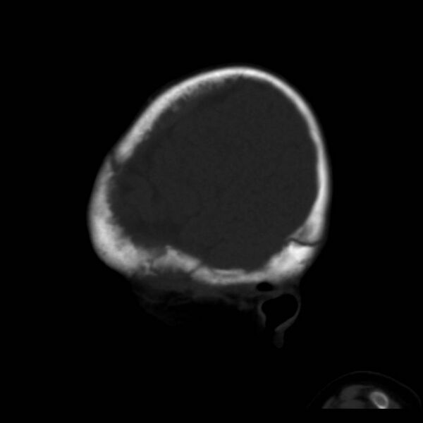 File:Neuroblastoma with skull metastases (Radiopaedia 30326-30958 Sagittal bone window 38).jpg