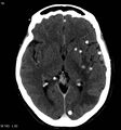 Neurocysticercosis (Radiopaedia 7773-8596 C+ delayed 7).jpg