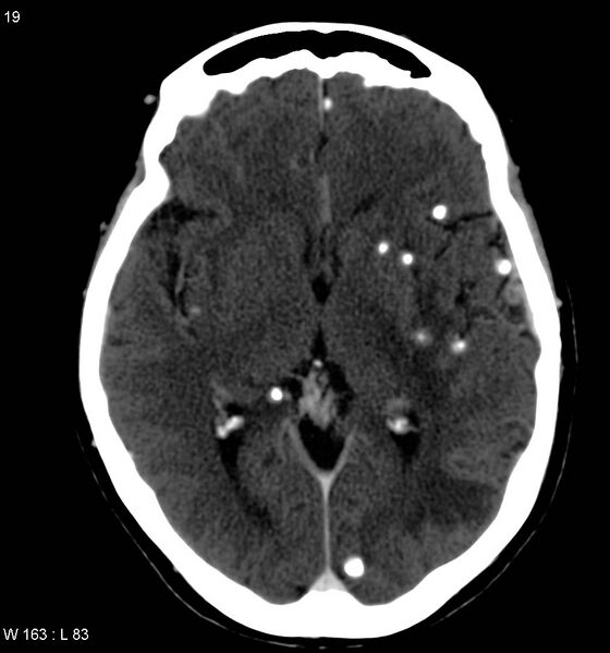 File:Neurocysticercosis (Radiopaedia 7773-8596 C+ delayed 7).jpg