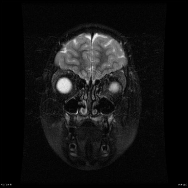 File:Neurofibromatosis type 1 (Radiopaedia 22541-22564 C 9).jpg