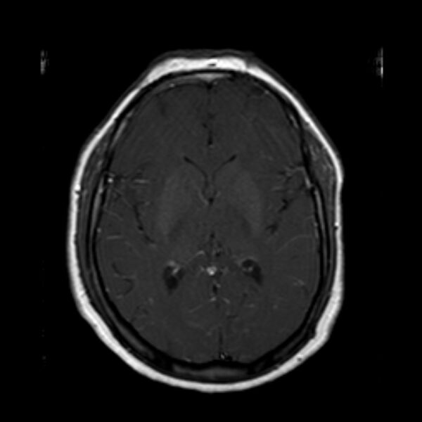 File:Neurofibromatosis type 2 (Radiopaedia 67470-76871 Axial T1 C+ 13).jpg