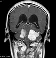 Neurofibromatosis type 2 - cranial and spinal involvement (Radiopaedia 5351-7111 Coronal T1 C+ 9).jpg