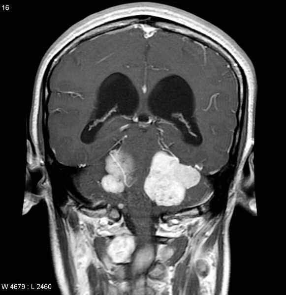 File:Neurofibromatosis type 2 - cranial and spinal involvement (Radiopaedia 5351-7111 Coronal T1 C+ 9).jpg