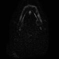 Non-Hodgkin lymphoma - parotid gland (Radiopaedia 71531-81890 Axial DWI 3).jpg