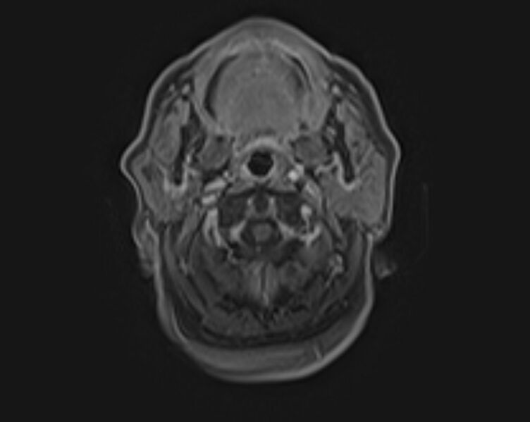 File:Non-Hodgkin lymphoma - parotid gland (Radiopaedia 71531-81890 E 14).jpg