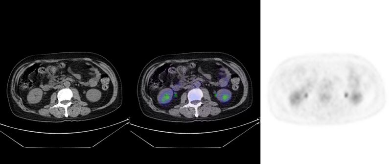 File:Non-Hodgkin lymphoma involving seminal vesicles with development of interstitial pneumonitis during Rituximab therapy (Radiopaedia 32703-33752 ax CT Fus PET 41).jpg