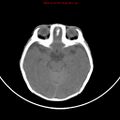 Non-accidental injury - bilateral subdural with acute blood (Radiopaedia 10236-10765 Axial non-contrast 8).jpg