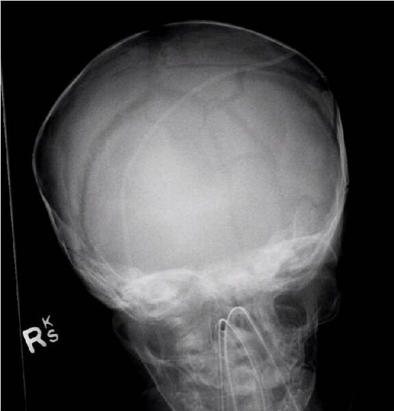 File:Non-accidental injury - intracranial injuries and skull fracture (Radiopaedia 17753-17507 Frontal 1).jpg