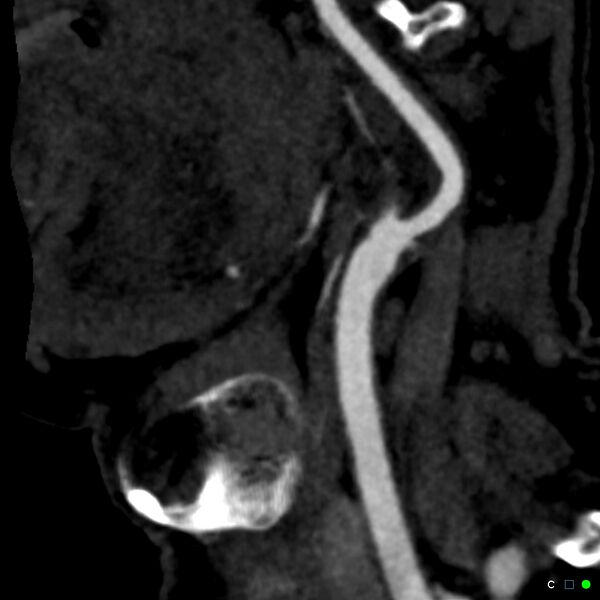 File:Non-occlusive intraluminal internal carotid artery thrombus (Radiopaedia 37751-39658 C 62).jpg