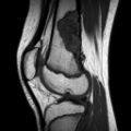 Non-ossifying fibroma - distal femur (Radiopaedia 8111-8947 Sagittal T1 1).jpg